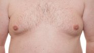 O primeiro tipo de aumento no peito masculino é mais conhecido como pseudoginecomastia - Reprodução/Portal Alexandre Senra
