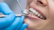 Além do AVC, o levantamento também identificou que a má condição dental está relacionada a um risco 36% maior de infartos - Reprodução/Shutterstock