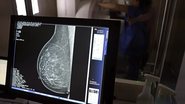 Imagem Exames gratuitos de mamografia chegam a parnamirim; saiba como ter acesso