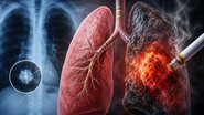 Imagem Câncer em órgãos respiratórios deve afetar mais de 7.000 pessoas no Nordeste em 2026; veja a situação do RN