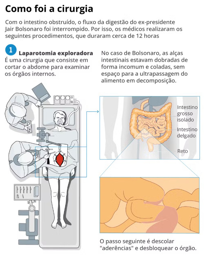 Entenda a cirurgia de Bolsonaro