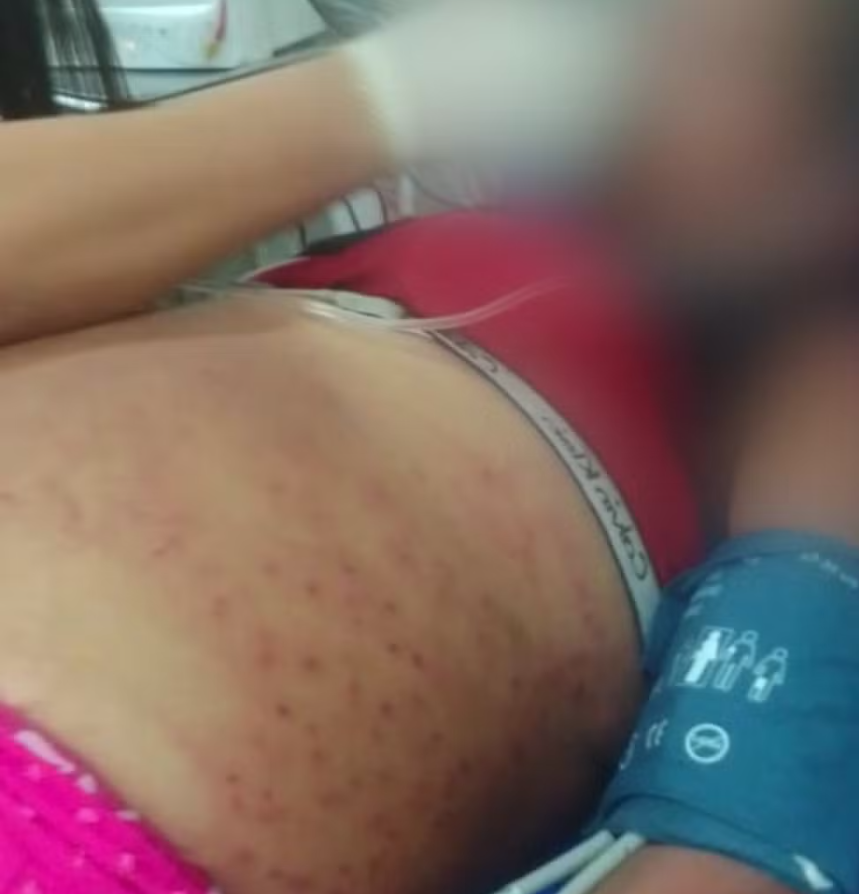 Mulher levou mais de mil picadas de abelha. Foto: Reprodução.