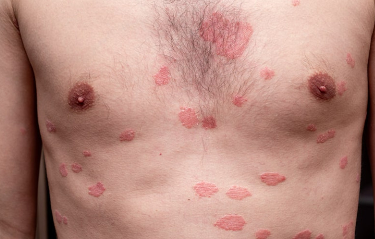Lúpus é uma doença inflamatória autoimune crônica que ocorre quando o sistema imunológico ataca tecidos saudáveis do corpo. Imagem: reprodução internet.