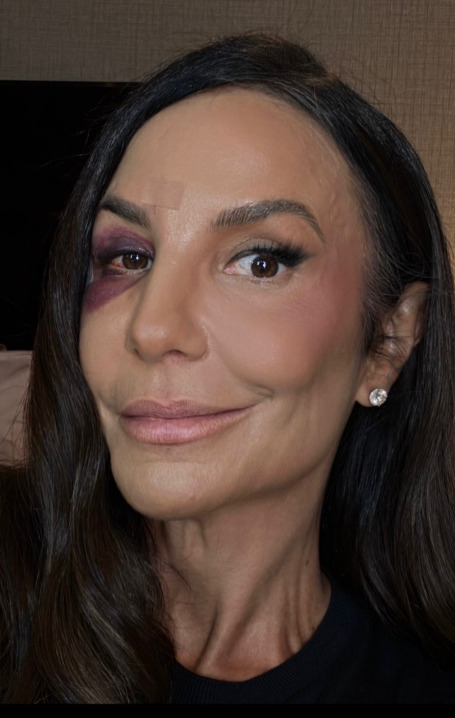 Na sexta-feira (27), durante outra apresentação no Ibirapuera, Ivete já havia contado ao público que desmaiou em casa e bateu a cabeça.