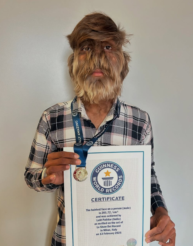 Um jovem indiano de 19 anos ganhou reconhecimento internacional após entrar para o Guinness World Records por possuir o rosto mais peludo do mundo.