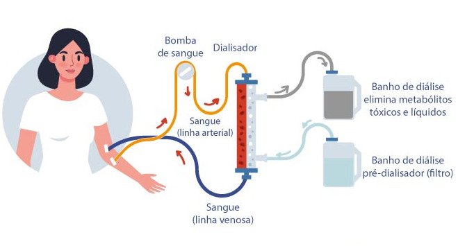 A diálise é um procedimento médico fundamental para pessoas que apresentam insuficiência renal, condição em que os rins perdem a capacidade de filtrar adequadamente o sangue.