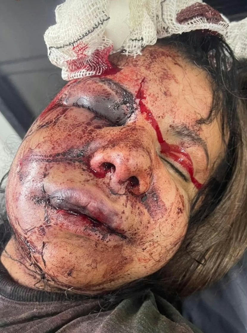 Juliana Garcia, ainda na ambulância, após levar mais de 60 socos